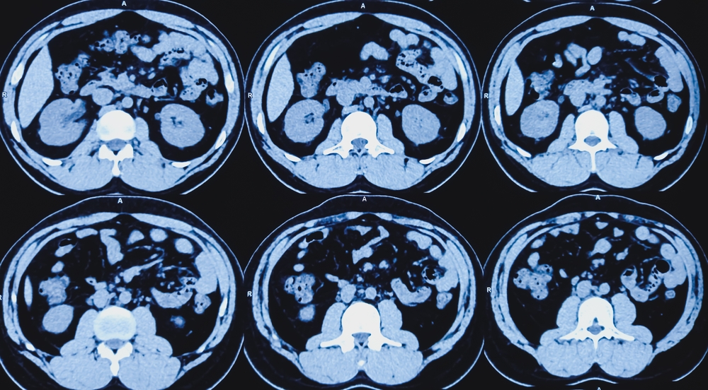 Ct,Scan,Of,Kub,(non-contrast):,Right,Lower,Ureteric,Calculus,(at